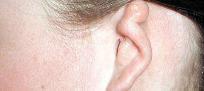 Malformación de oido